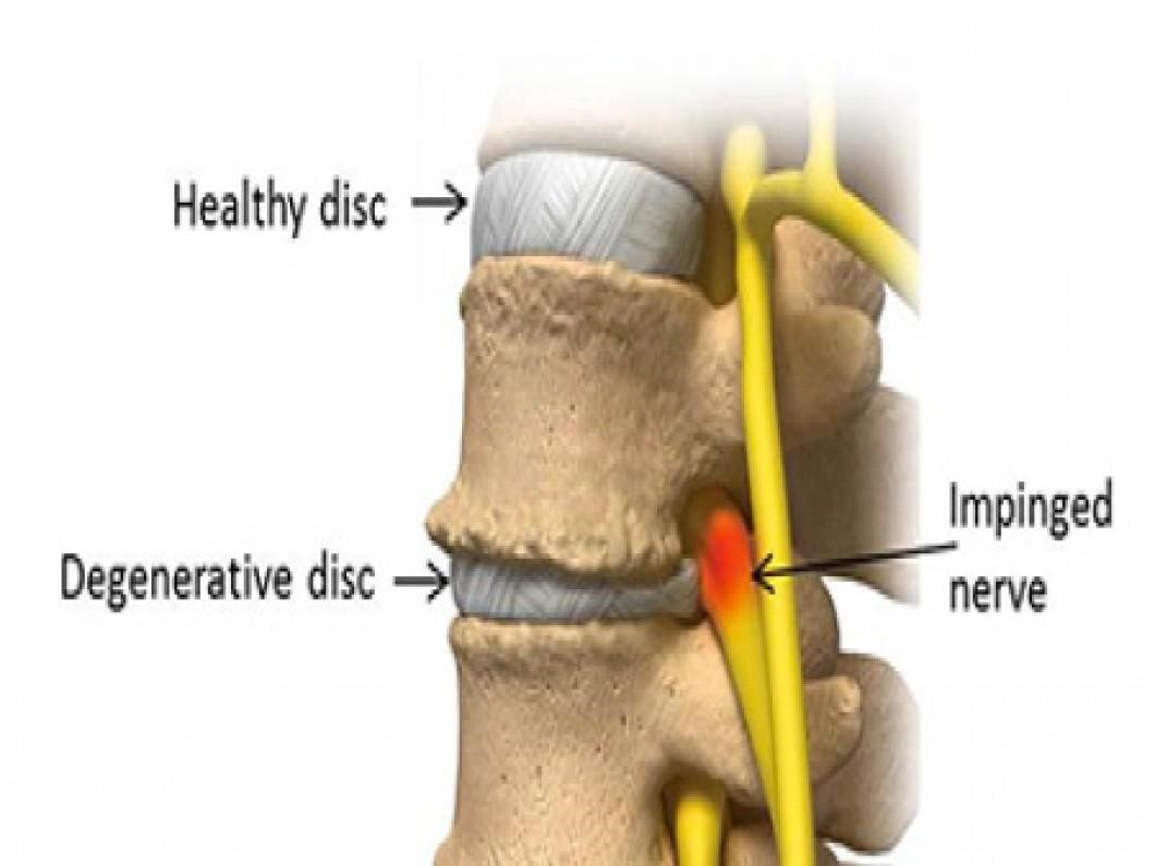 herniated disc