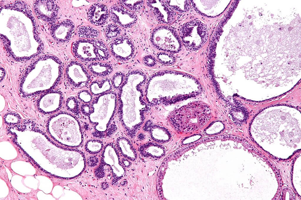 image of fibrocystic breast tissue