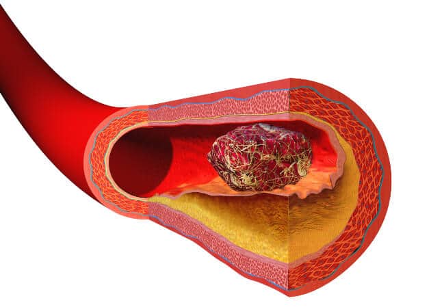 image of blood vessel with blood clot