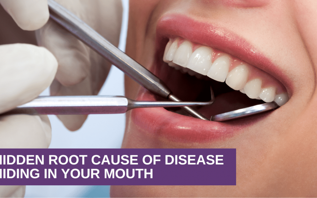 Hidden Root Cause of Disease Hiding In Your Mouth